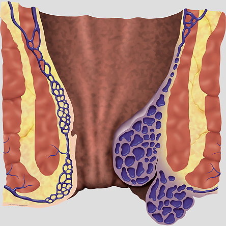 Как выглядит шишка геморроя фото Как выглядит шишка геморроя фото