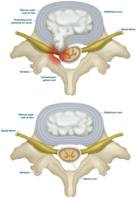Central Disc Prolapse – Slipped disc – DLPF