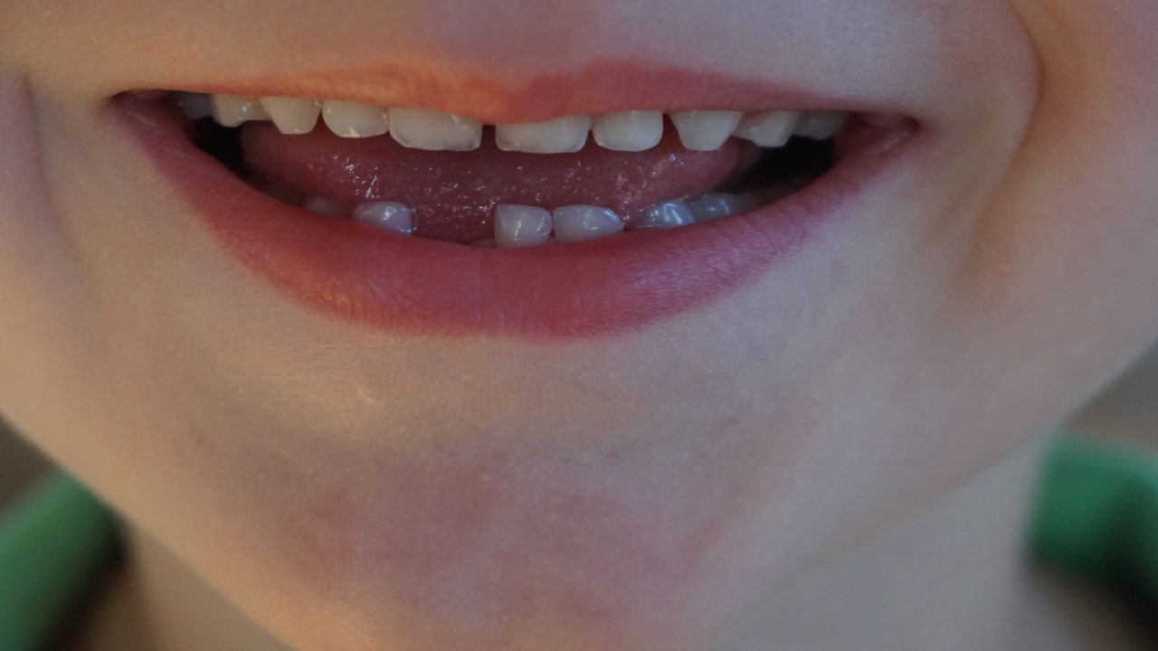 Kid missing tooth