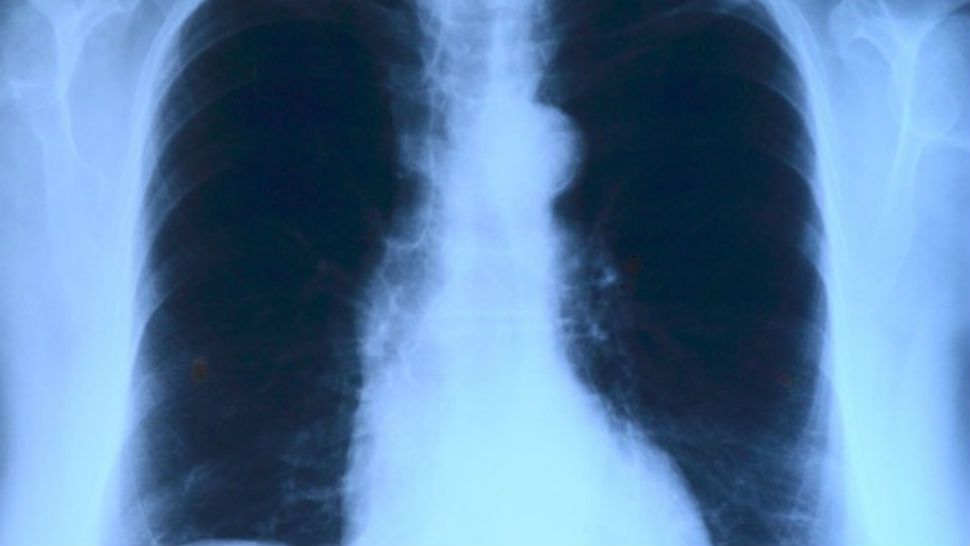 FILE- X-ray of lungs. 