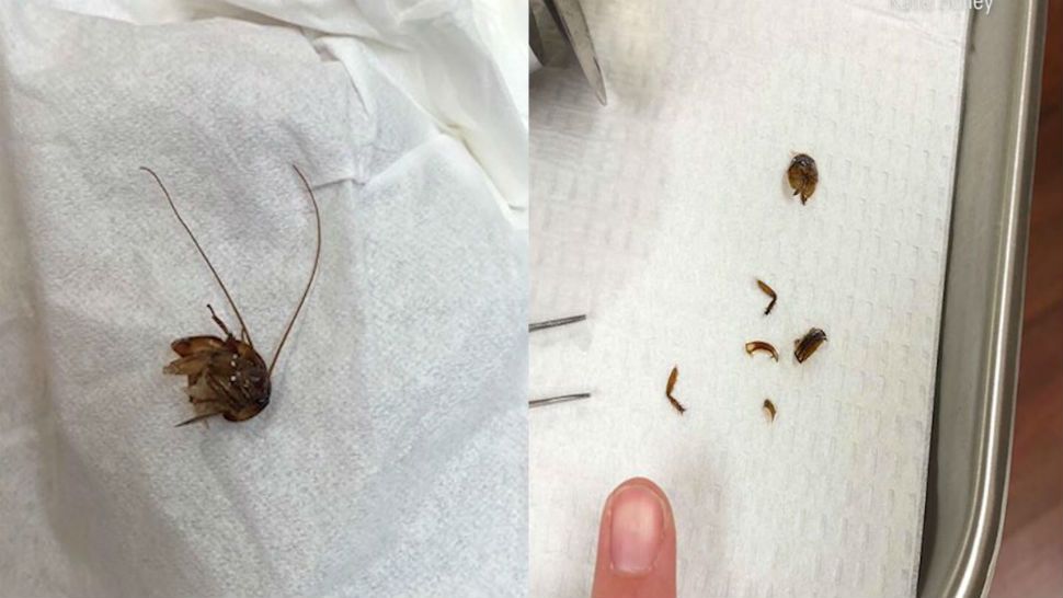 A Florida woman had a roach removed from ear canal piece by piece. (Katie Holley)