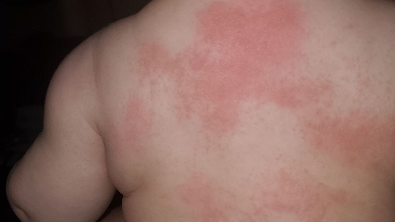 infant red pinpoint rash