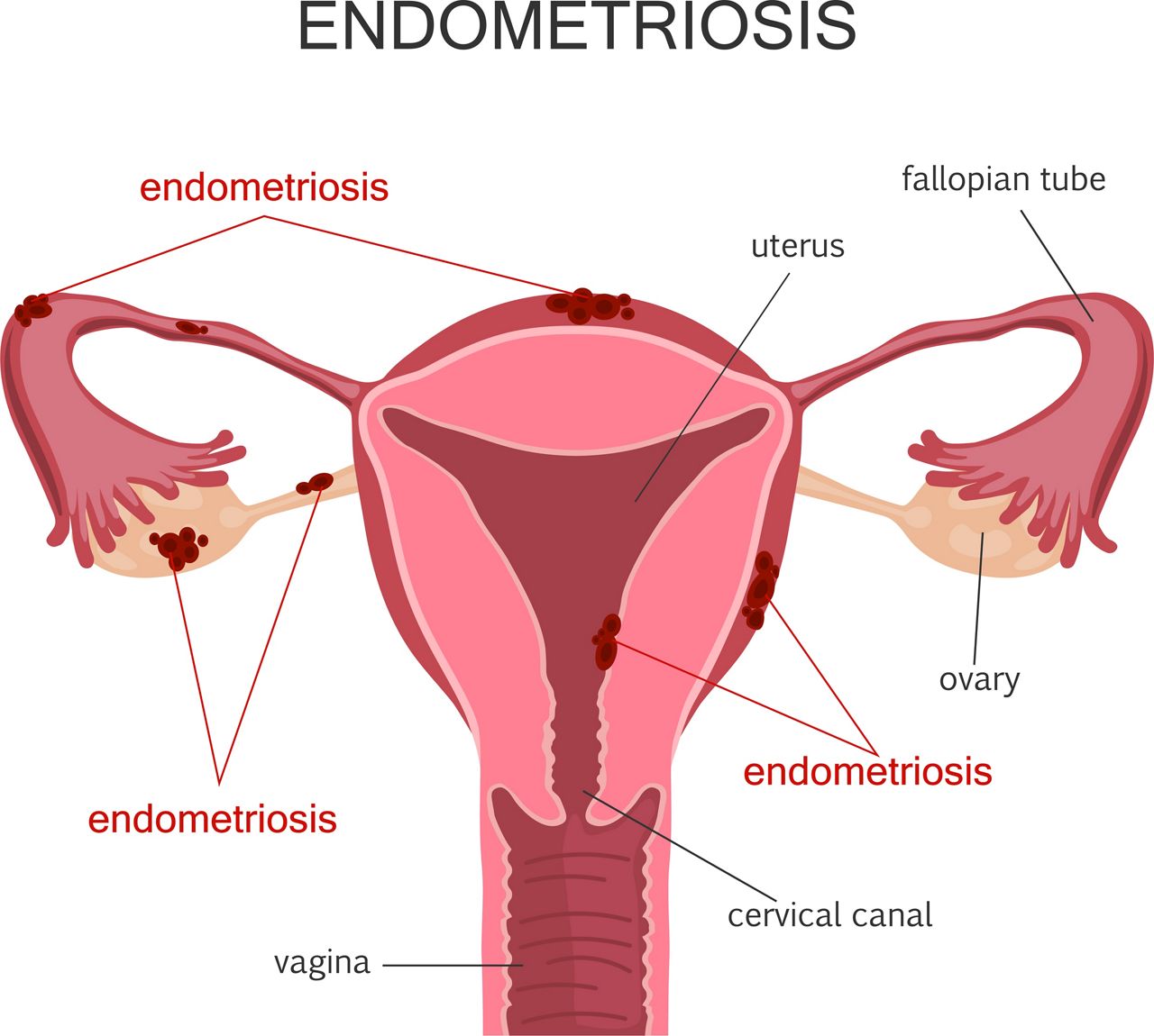 norton-gynecologist-explains-fibroids-and-endometriosis