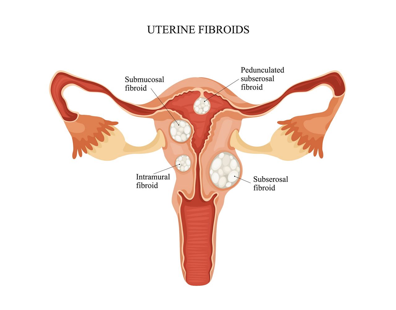 norton-gynecologist-explains-fibroids-and-endometriosis