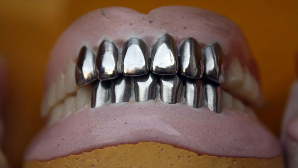 FILE photo of dentures with silver teeth. 