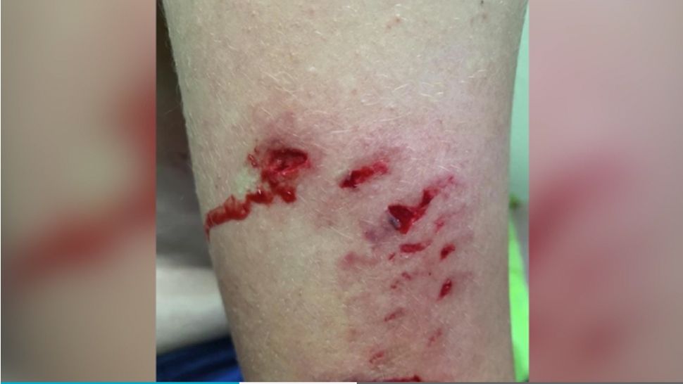 dog bites on human leg