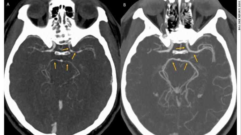 (A) CT angiography showing unexpected luminal narrowing in the left supraclinoid internal carotid artery, M1 segment of bilateral middle cerebral arteries, and P1 segments of bilateral posterior cerebral arteries consistent with vasospasm. (B) CT angiography showing resolution of luminal narrowing after 5 weeks of supportive care.
