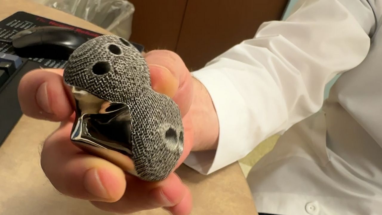 3D printed bones used to help patients in rare surgery 