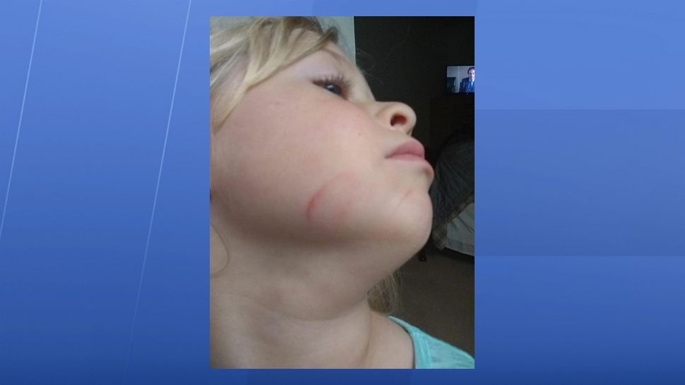 Photo courtesy of Joshua Jones of the scratches he found on his daughter's face.