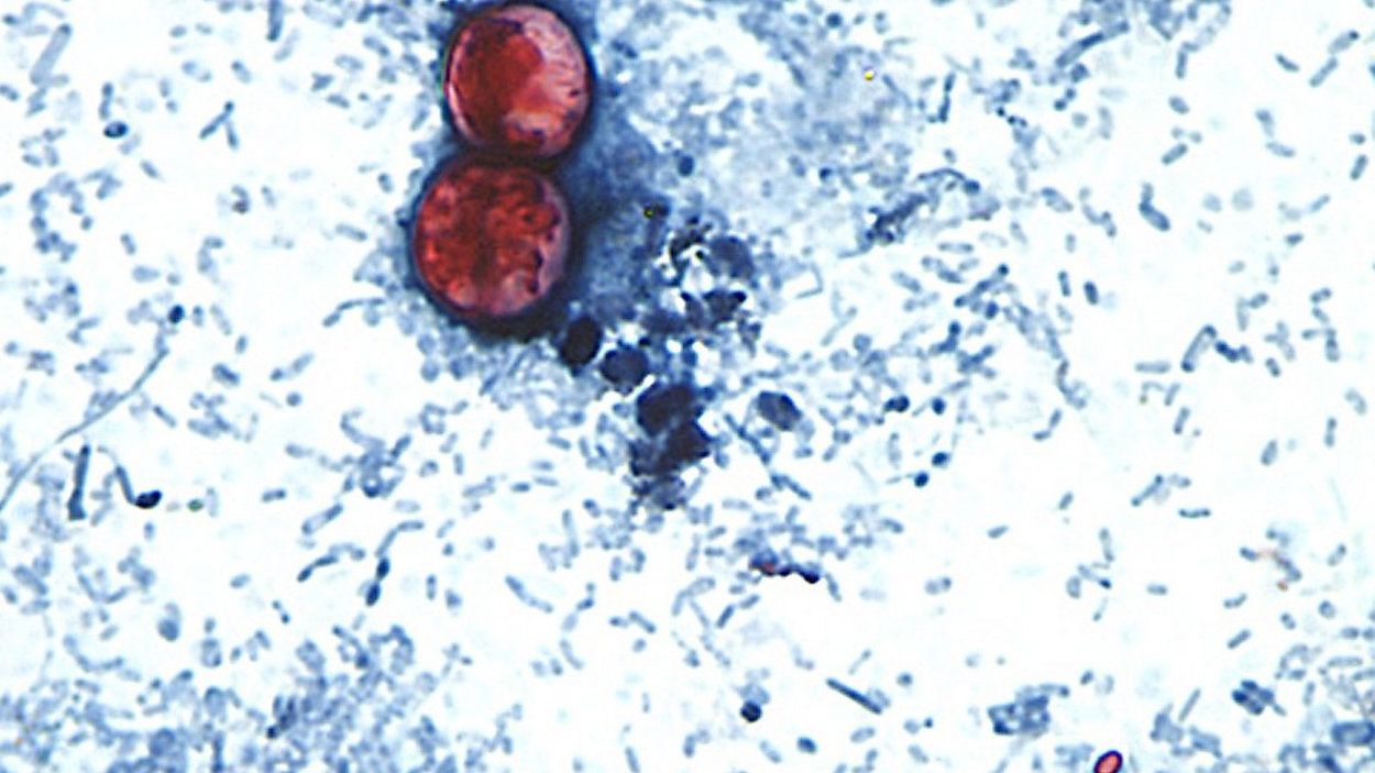 NYC health officials probe continued rise in cyclosporiasis cases