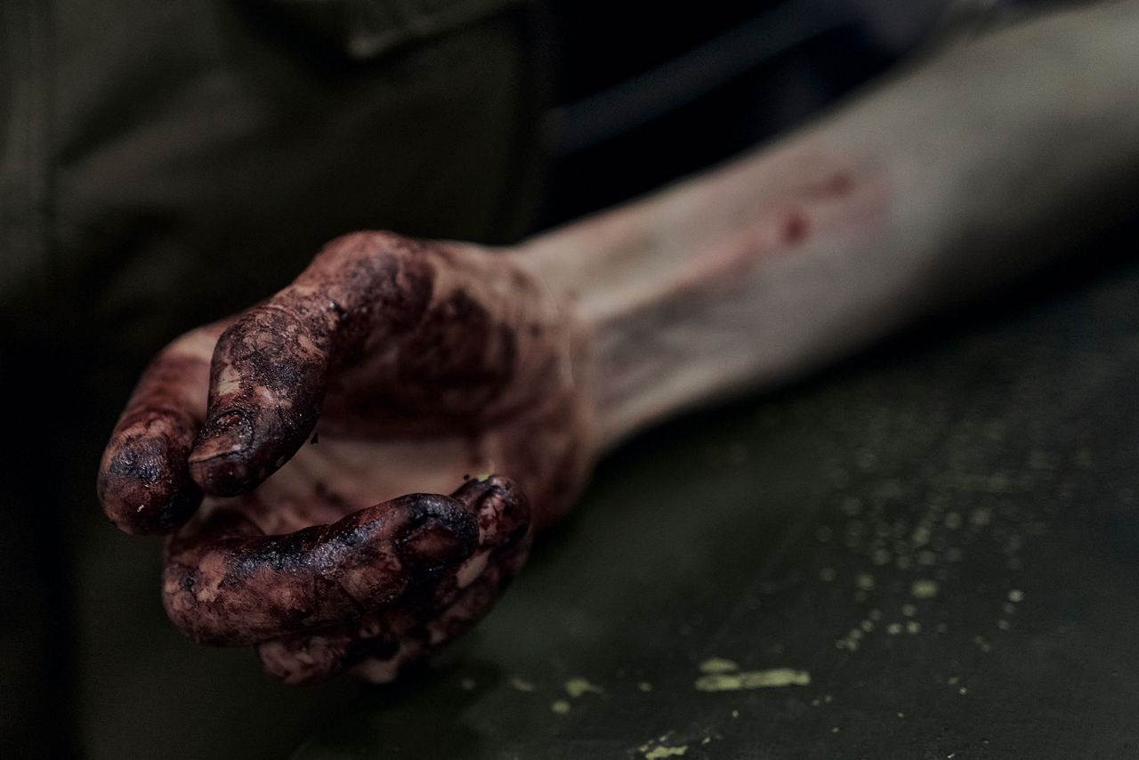 The blood covered hand of a Ukrainian wounded soldier who gets the first ai...