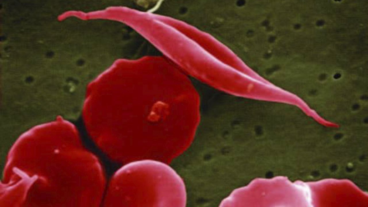This electron microscope image provided by the National Institutes of Health in 2016 shows a blood cell altered by sickle cell disease, top. (National Center for Advancing Translational Sciences (NCATS), National Institutes of Health via AP)