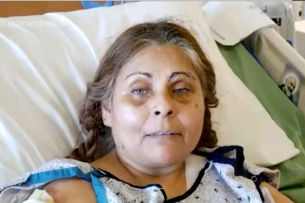 Factory explosion survivor, on fire, fell into chocolate vat