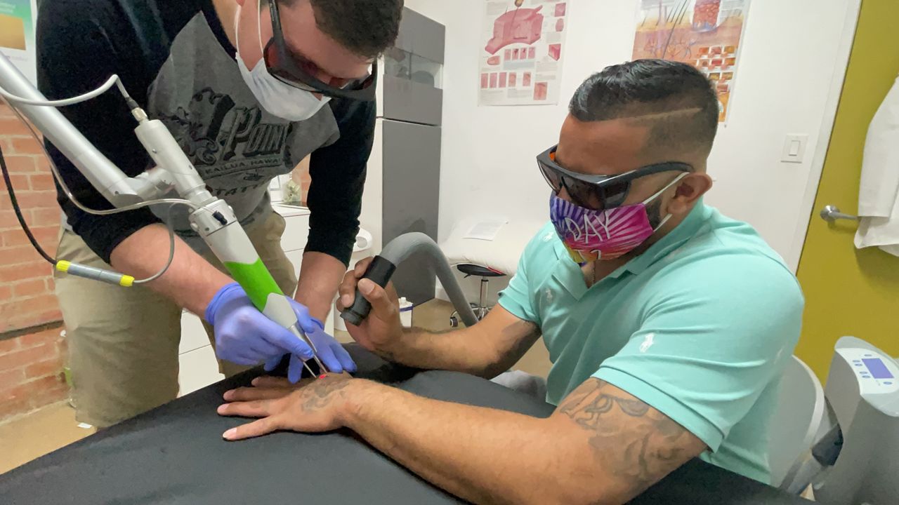 free tattoo removal programs near me