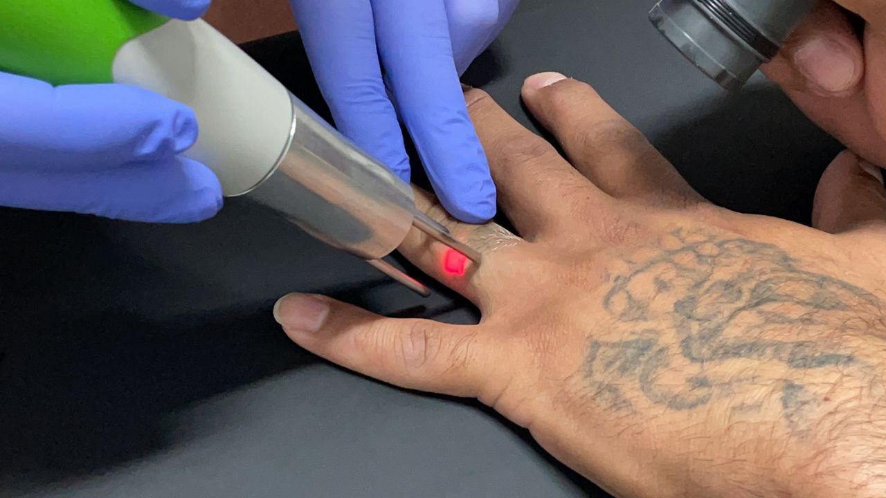 Free Laser Tattoo Removals For Ex Convicts