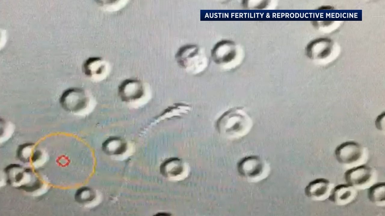 One relatively unknown treatment for men facing infertility issues is micro-dissection testicular sperm extraction, which can be used in IVF treatments. (Spectrum News 1/Dylan Scott)