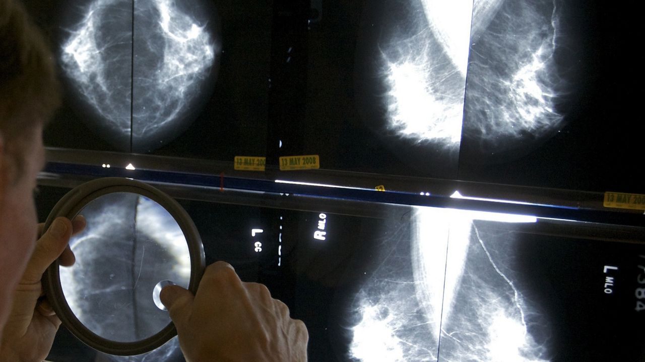 A radiologist uses a magnifying glass to check mammograms for breast cancer in Los Angeles, May 6, 2010. (AP Photo/Damian Dovarganes)