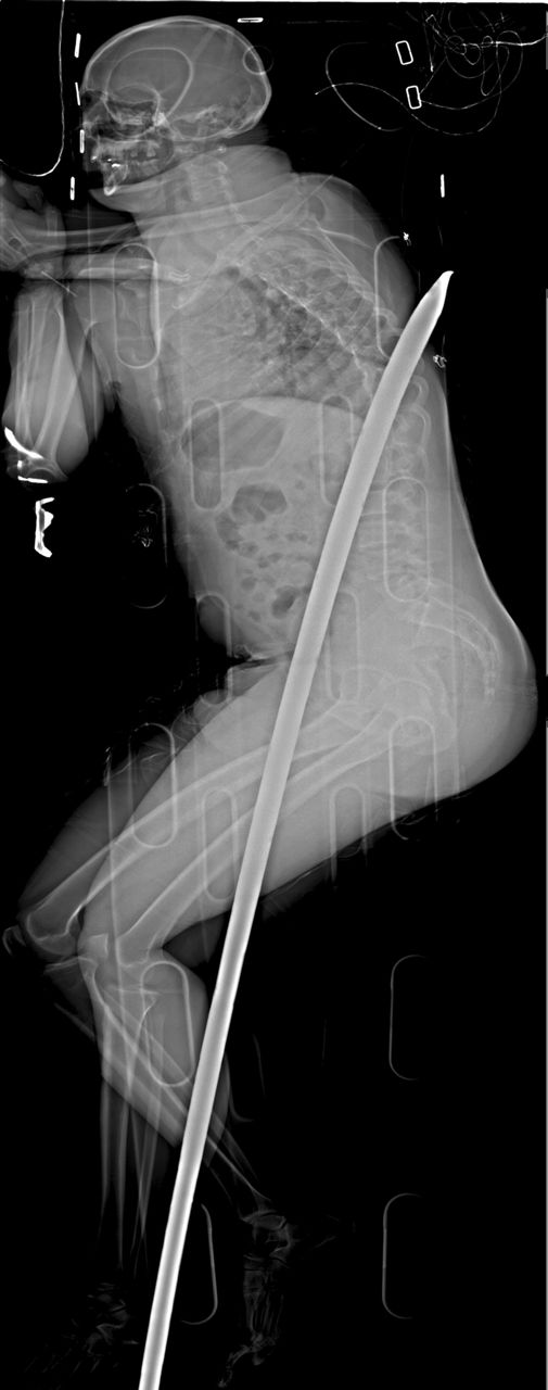 South African man who survived impaling to run ultramarathon