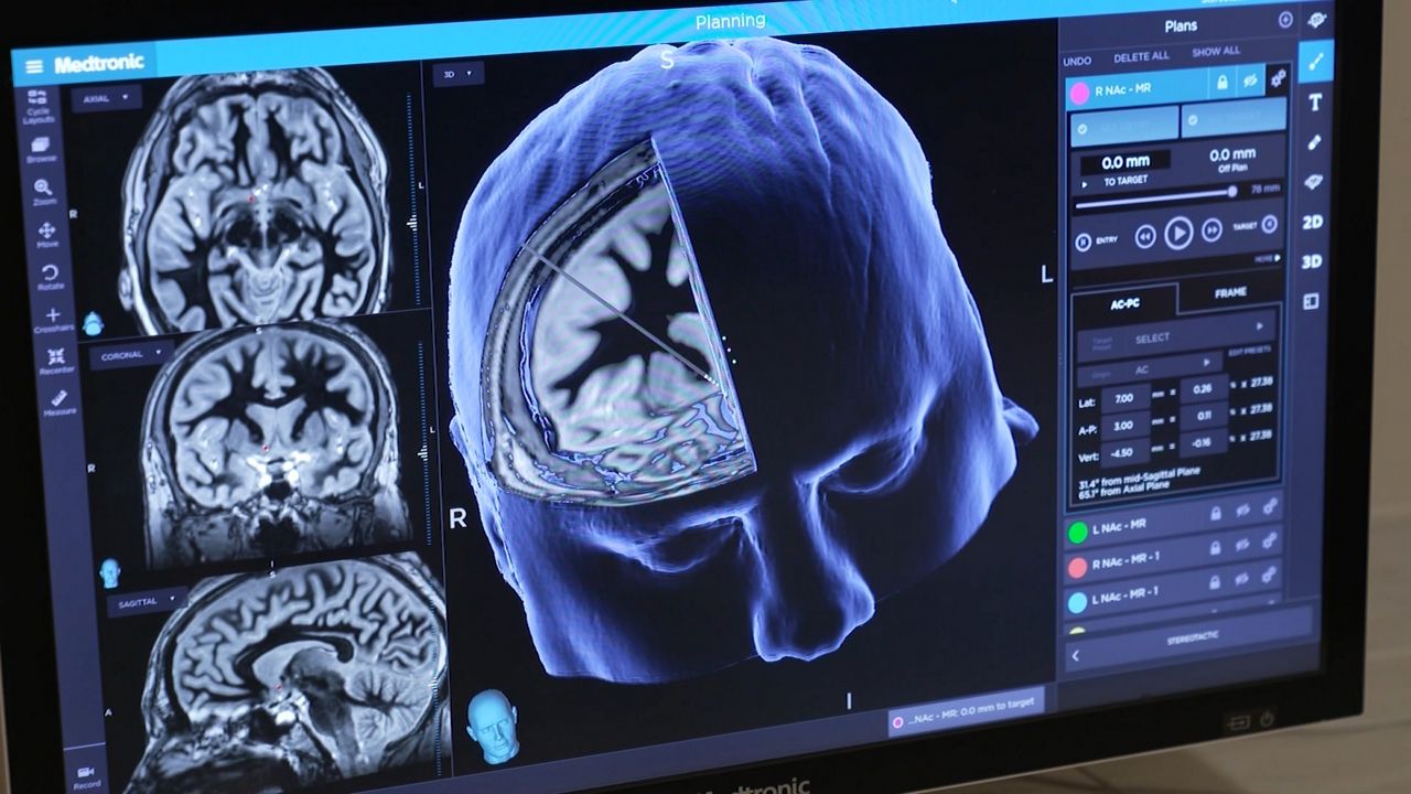 alzheimer's brain scans
