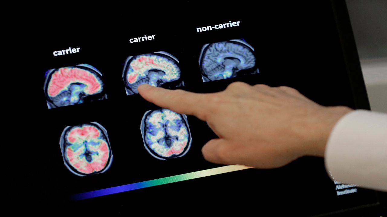 Alzheimer's brain scans