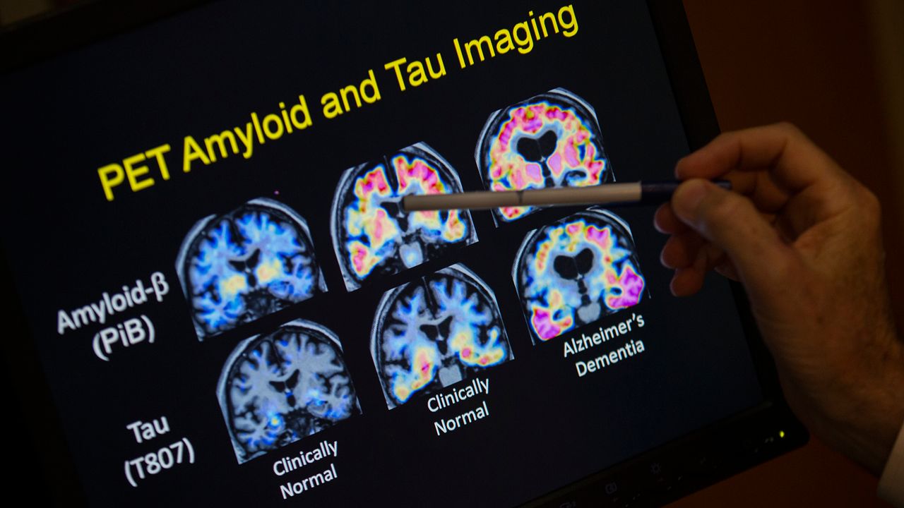 A doctor points to PET scan results that are part of a study on Alzheimer's disease at Georgetown University Hospital, on Tuesday, May 19, 2015, in Washington. (AP Photo/Evan Vucci, File)