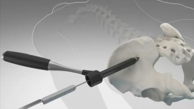 New Procedure Stabilizes Back Joints to Ease Chronic Pain