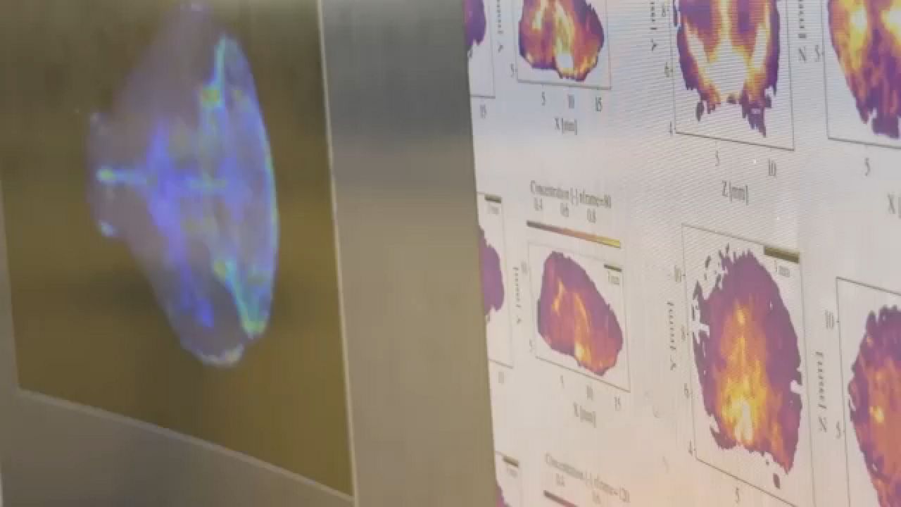 U of R research uses AI to connect brain fluid research and Alzheimer's