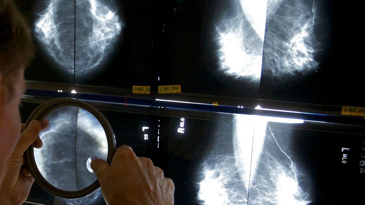 A doctor examines breast cancer scans (FILE PHOTO).
