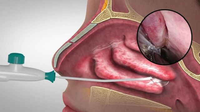 A new device offers relief beyond traditional nasal spray