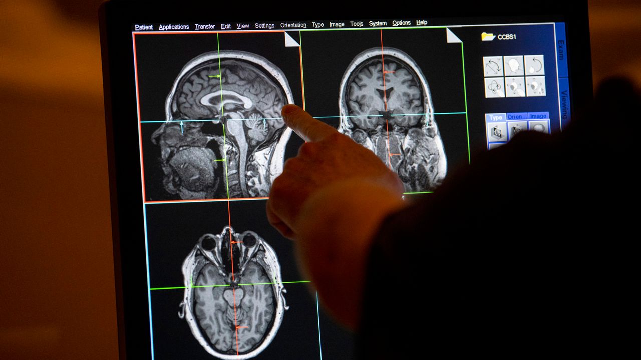 Calls for continued brain injury coverage increase across NY