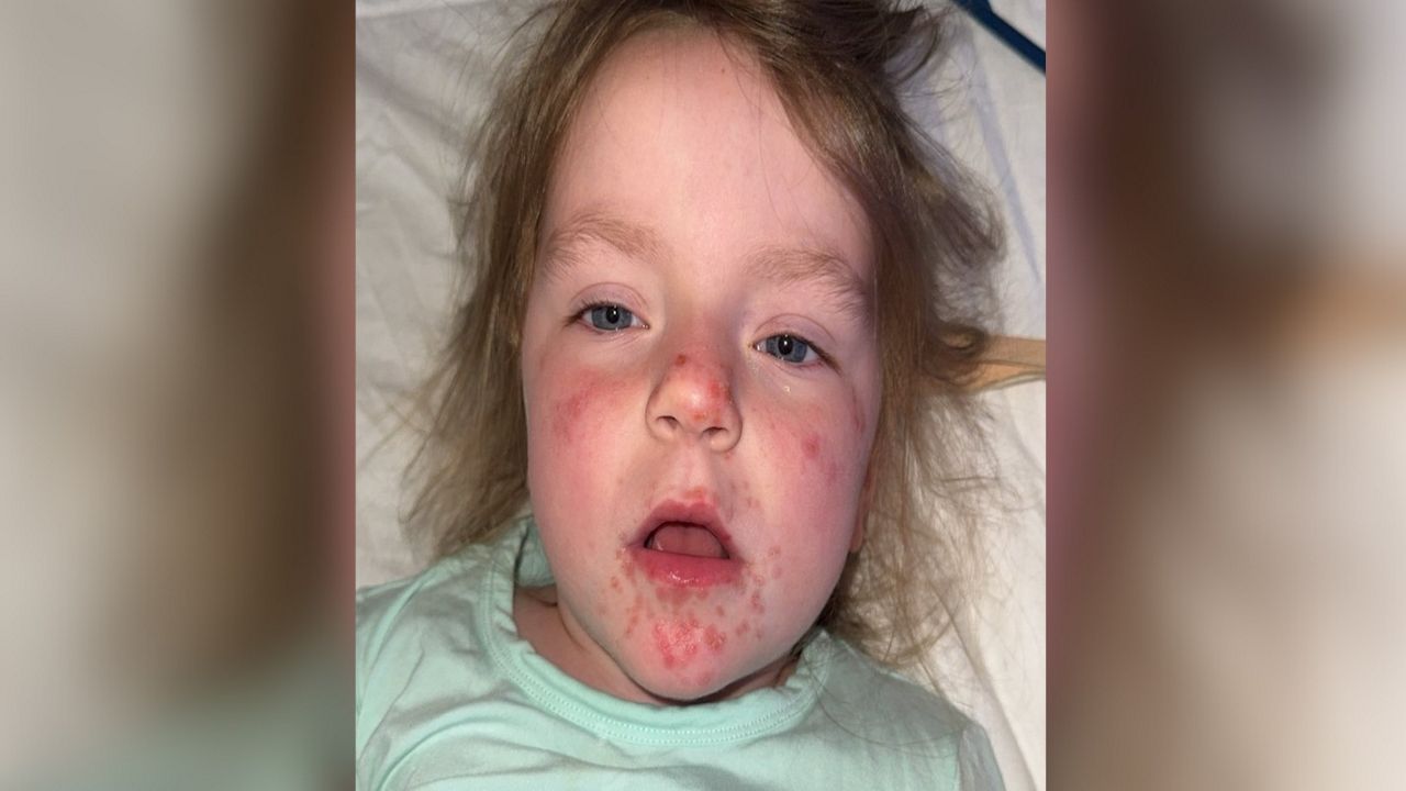 Hand, foot and mouth disease spread in Wisconsin schools