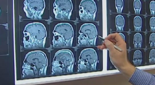 Nature or Nurture: How CTE Can Affect Athlete Behaviors