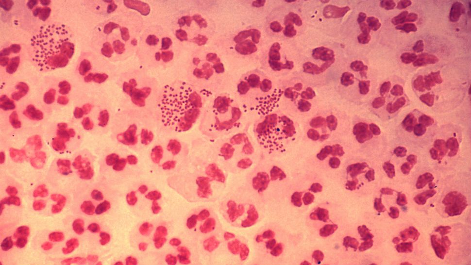 Gram-stain of gonococcal urethritis. Note distribution in neutrophils and presence of both intracellular and extracellular bacteria. (Image/CDC)