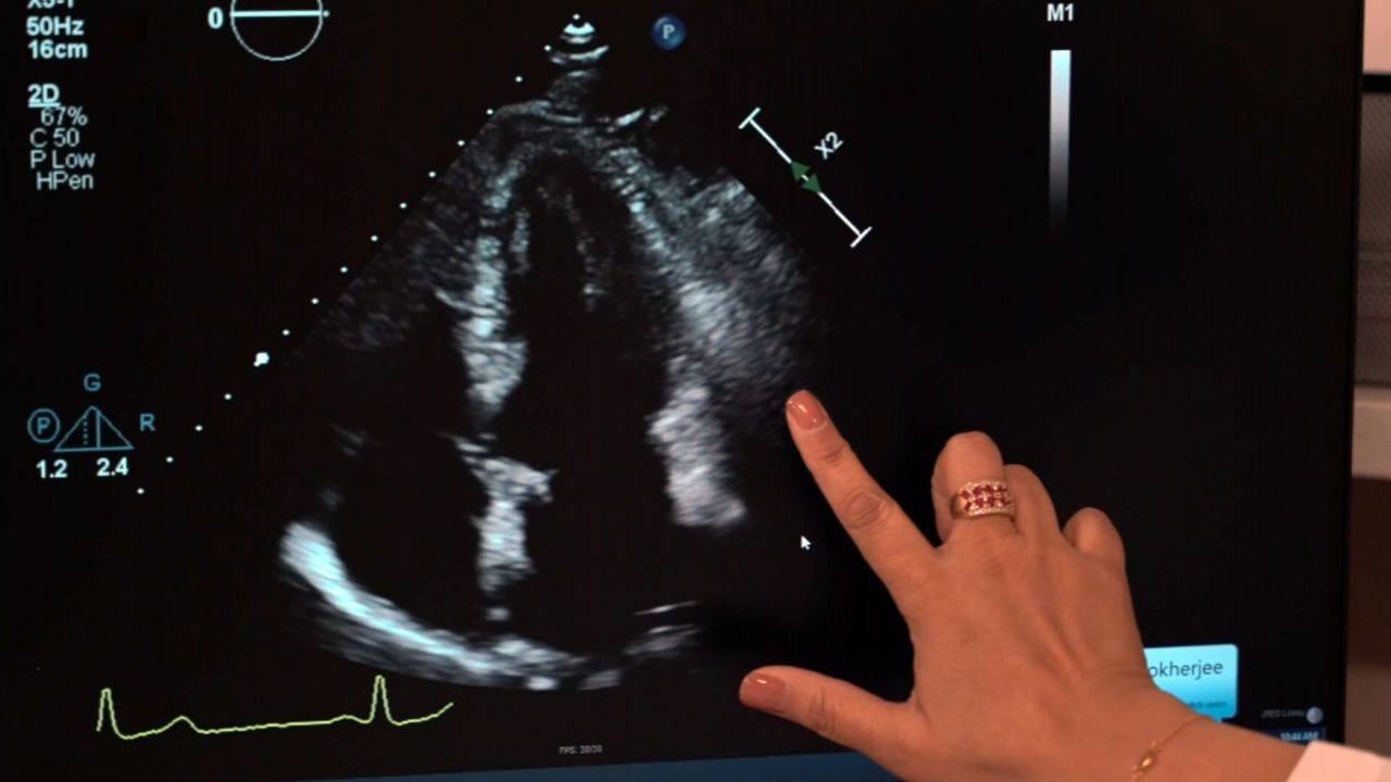 Rare heart disease What you need to know