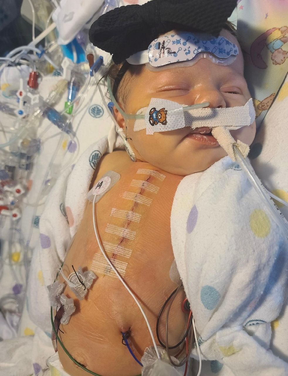 Charley Grace after an open heart surgery. (Credit: Lynsey Alverson)