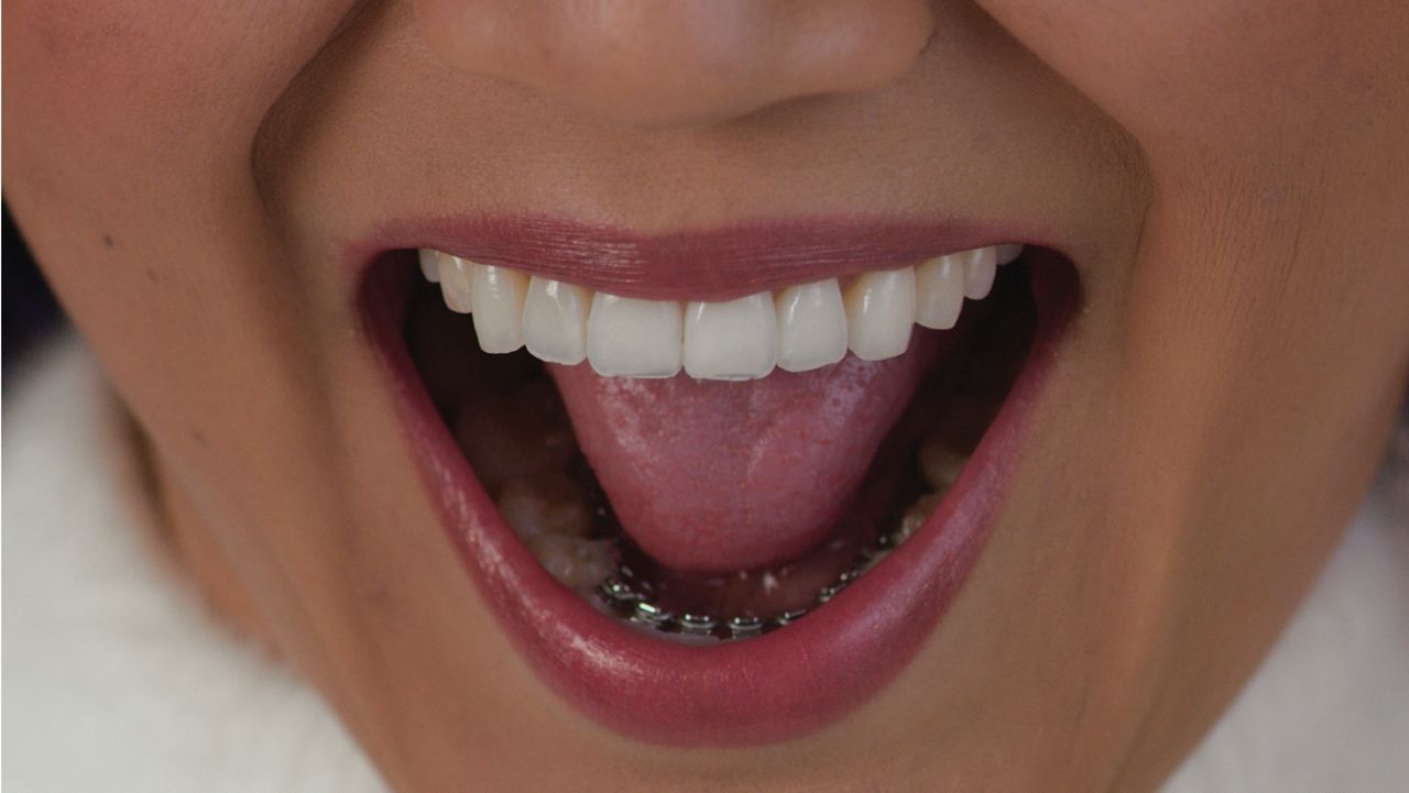 A woman shows off her InBrace, a smartwire placed behind the teeth that helps straighten teeth (Courtesy InBrace)