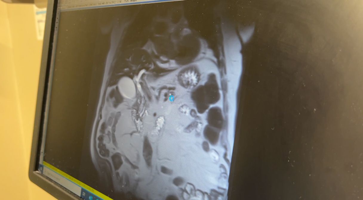 Milwaukee VA part of nation’s largest liver cancer screening