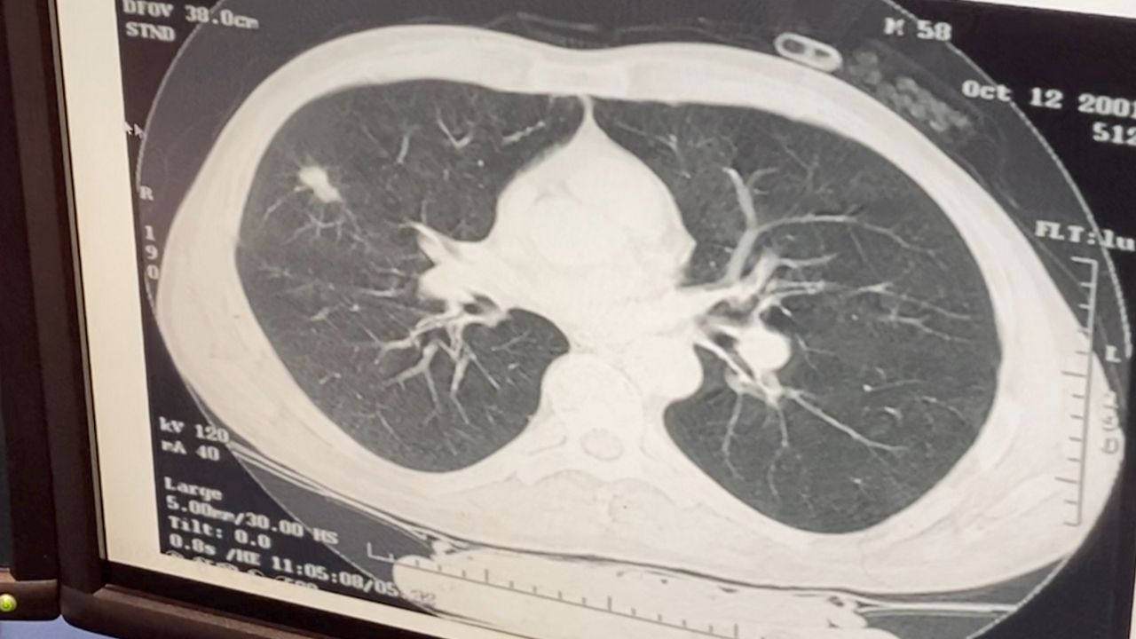 ‘Breath of Hope’ for lung cancer patients 