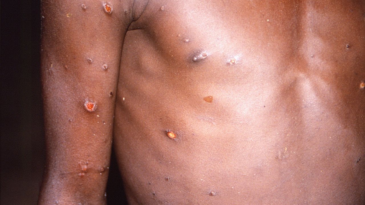 State and local public health officials say risk of Monkeypox remains very  low