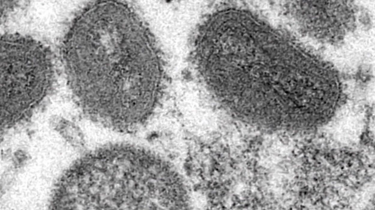 This 2003 electron microscope image made available by the Centers for Disease Control and Prevention shows mature, oval-shaped monkeypox virions, left, and spherical immature virions, right, obtained from a sample of human skin associated with the 2003 prairie dog outbreak. (Cynthia S. Goldsmith, Russell Regner/CDC via AP)