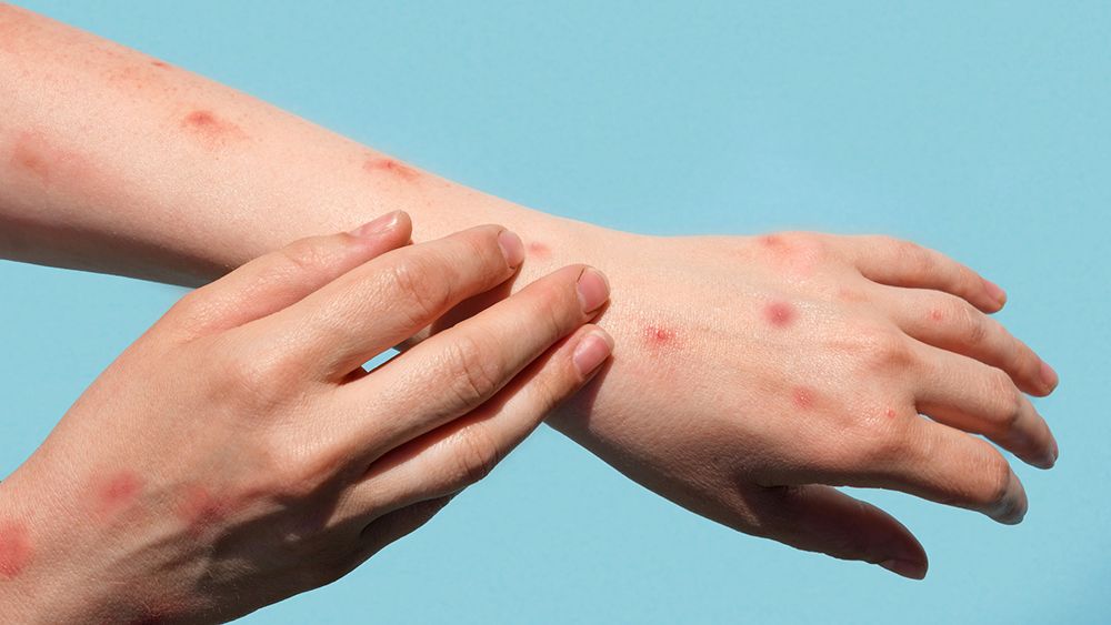 This photo shows some visible symptoms of a person infected with monkeypox. (Getty Images)