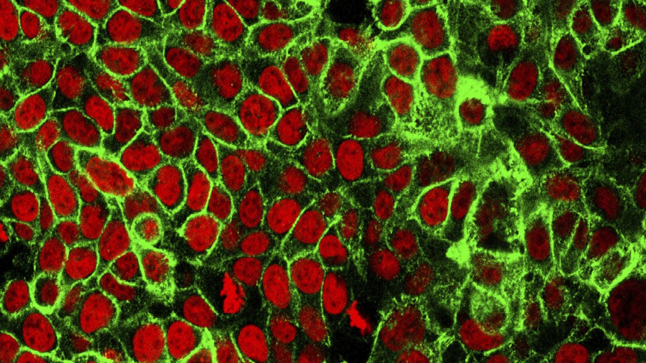 FILE - This microscope image shows human colon cancer cells with the nuclei stained red. (NCI Center for Cancer Research via AP, File)