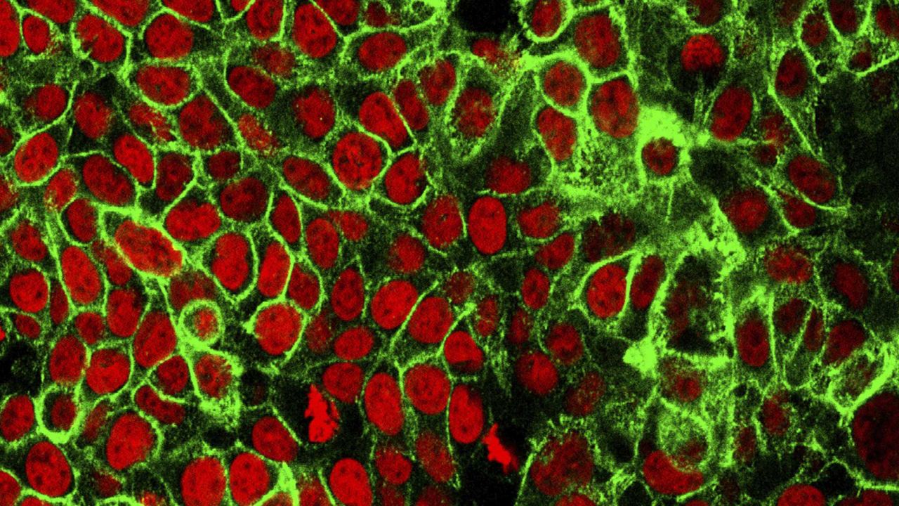 FILE - This microscope image made available by the National Cancer Institute Center for Cancer Research in 2015 shows human colon cancer cells with the nuclei stained red. (NCI Center for Cancer Research via AP, File)