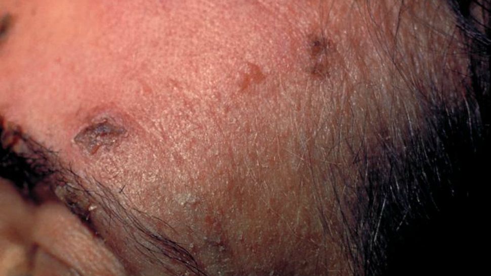 Skin lesions on the forehead of an elderly woman caused by the herpes zoster virus. (Credit: CDC)