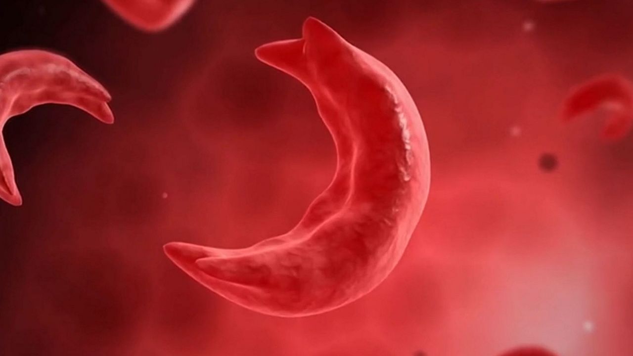 Sickle cell disease up close. (AP Photo)