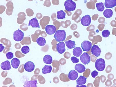 Acute Lymphoblastic Leukemia (ALL) In Children And Teens - Together