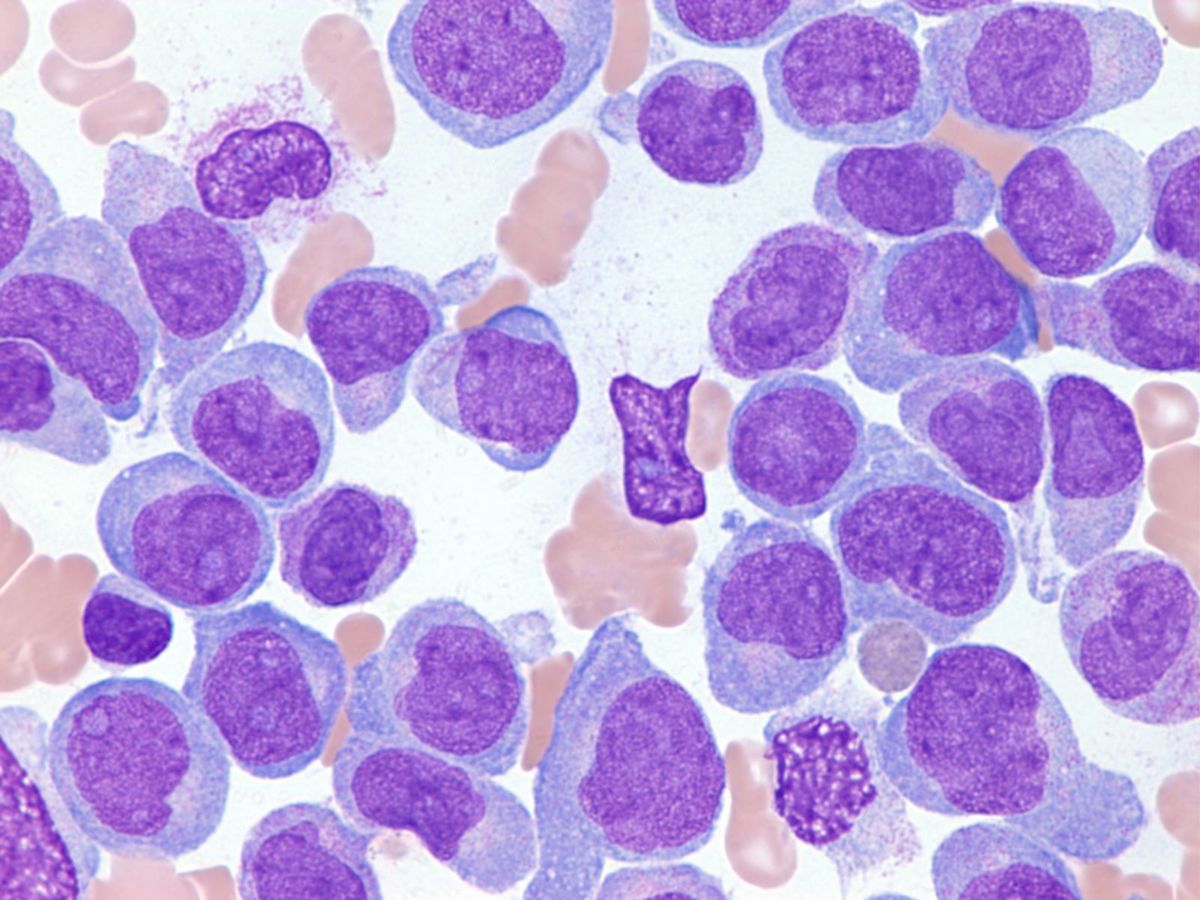 Acute Myeloid Leukemia (AML) in Children and Teens - Together