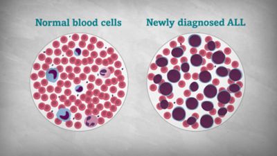 Acute Lymphoblastic Leukemia (ALL) In Children And Teens - Together